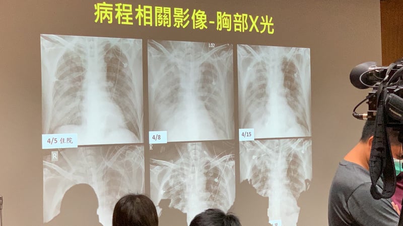 A先生肺部X光医治过程变化。（记者夏小华翻摄）